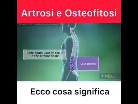 Come sciogliere gli osteofiti