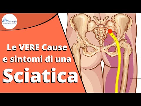 Disinfiammare il nervo sciatico senza farmaci