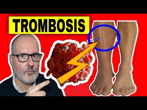 Trombosi riposo o movimento